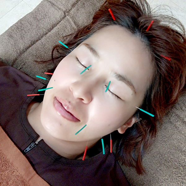 髪の毛くらいの細さの鍼(はり)で施術